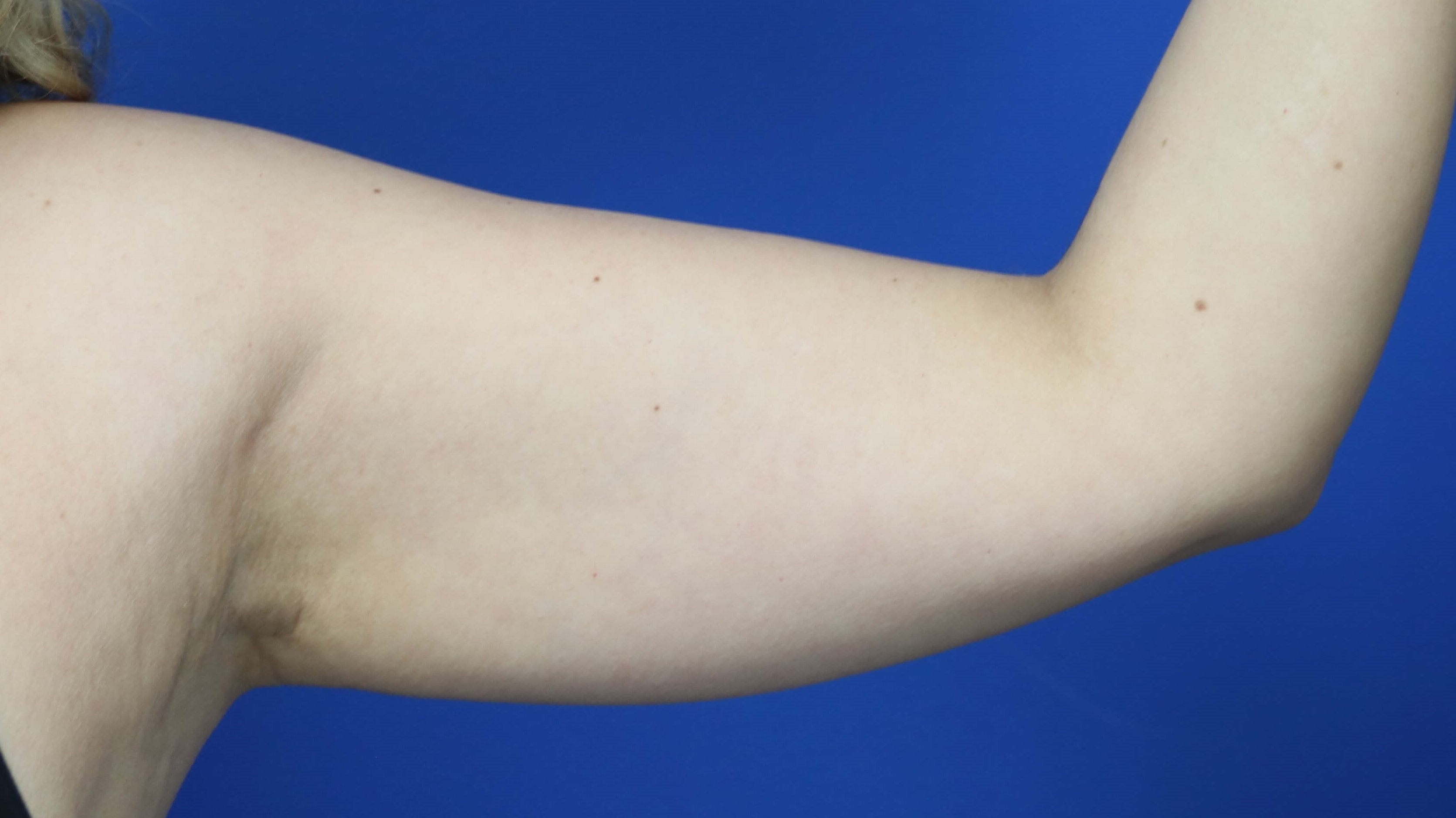 Front view of 50 year-old arm